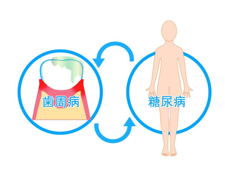 糖尿病と歯周病って関係があるの？ 明石市大久保町の歯医者・歯科 あかね歯科クリニック｜歯周病｜糖尿病